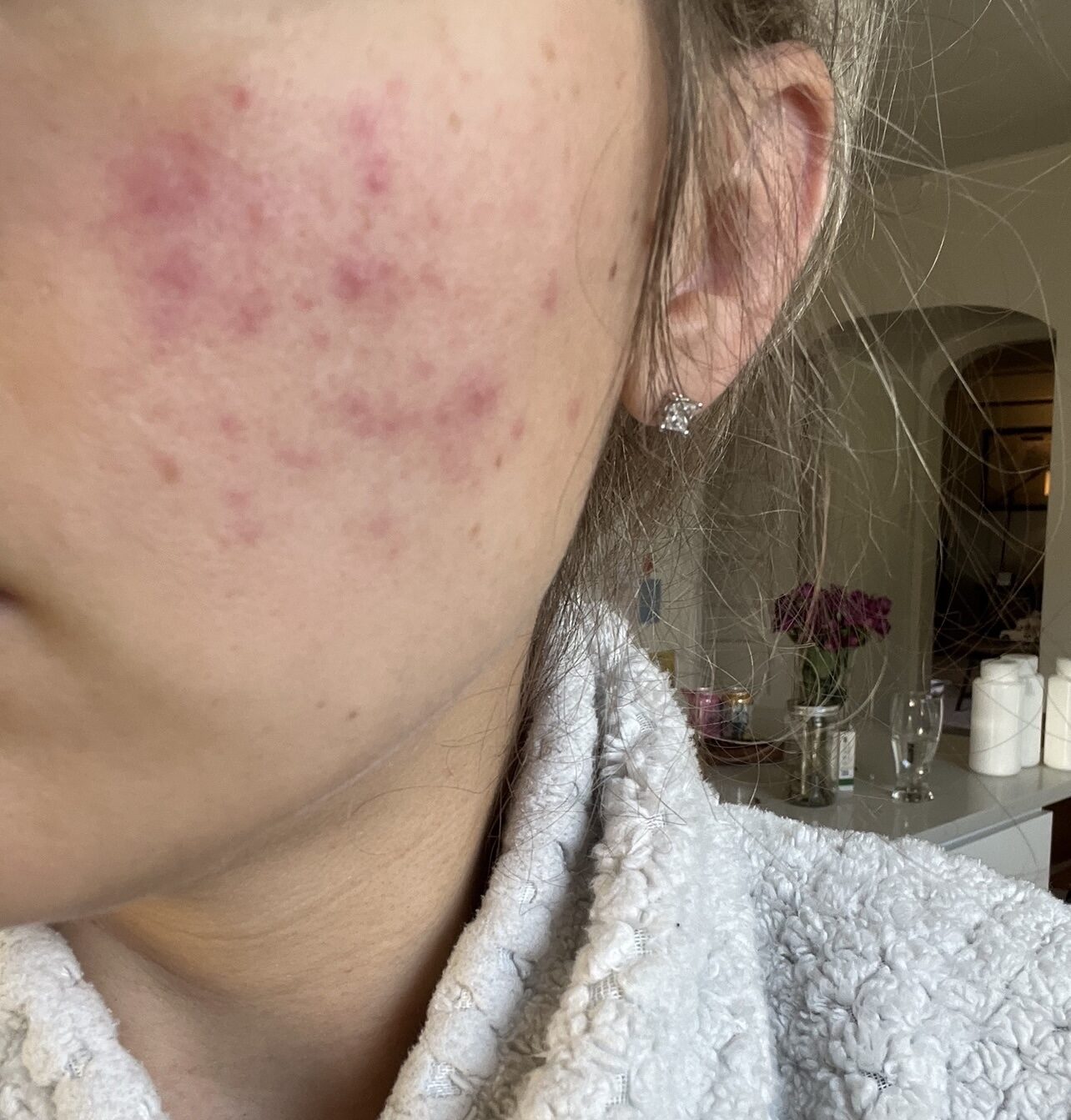 close up of spots and rash on face